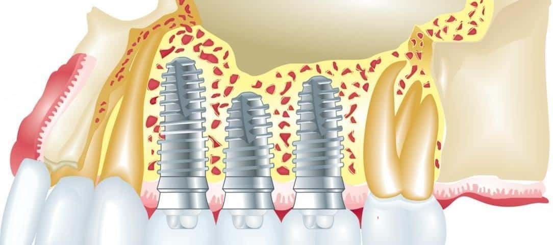 dental implants abroad