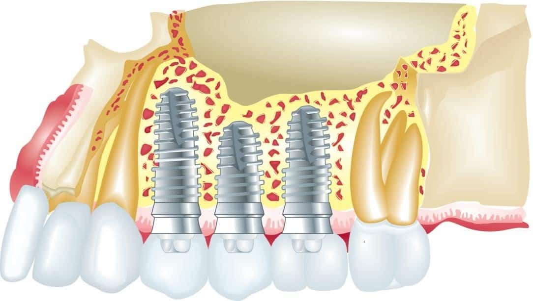 dental implants abroad