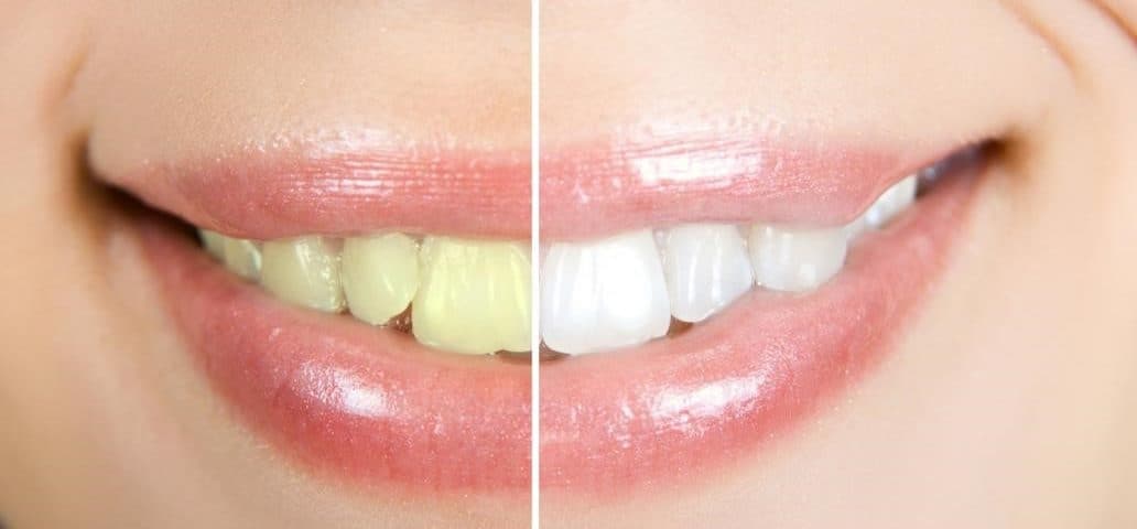 Home Kits vs Zoom Teeth Whitening in Costa Rica