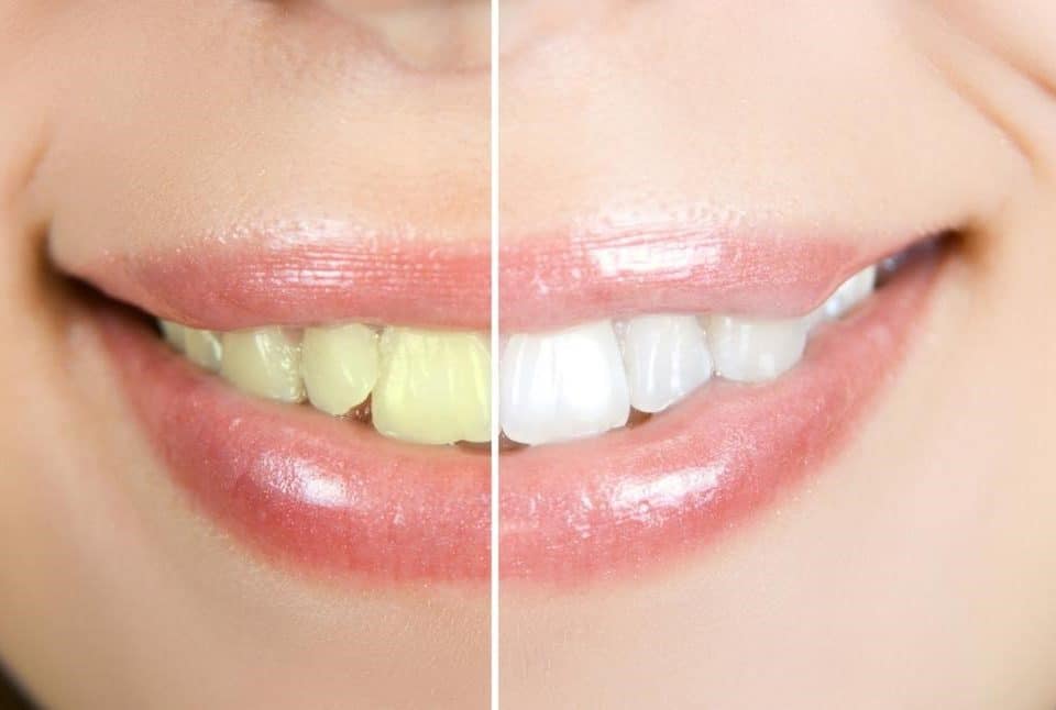 Home Kits vs Zoom Teeth Whitening in Costa Rica