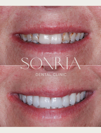 Restauración Completa de Boca en Sonria Dental Clinic Costa Rica